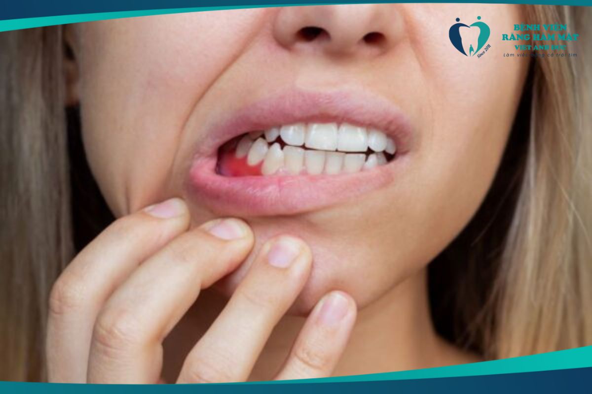 Bệnh viêm nha chu