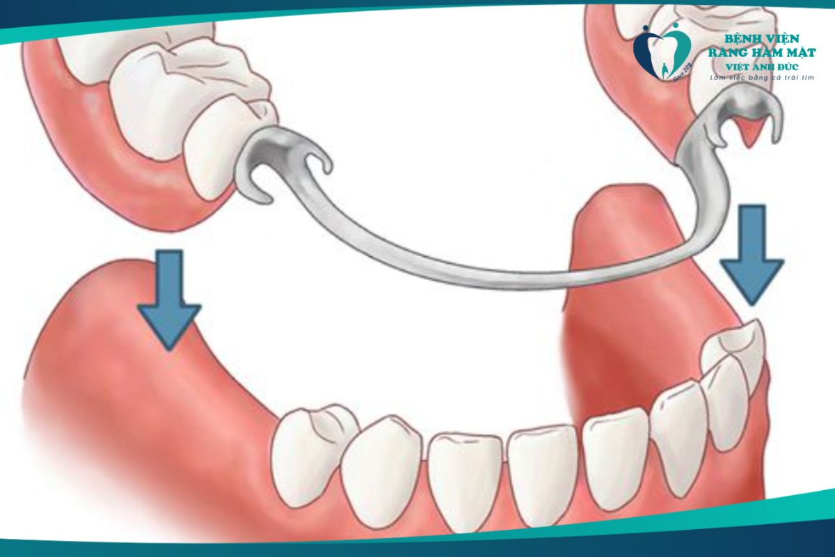 Hàm giả bán phần 