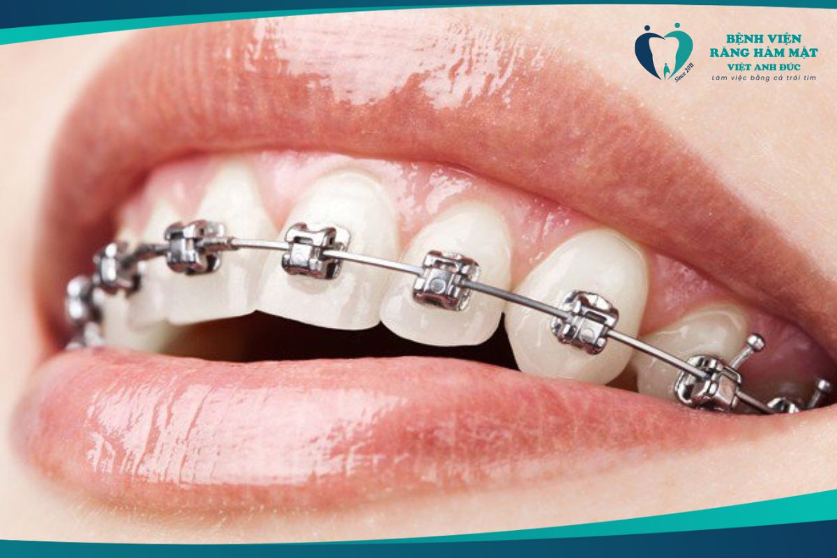 Niềng răng mắc cài