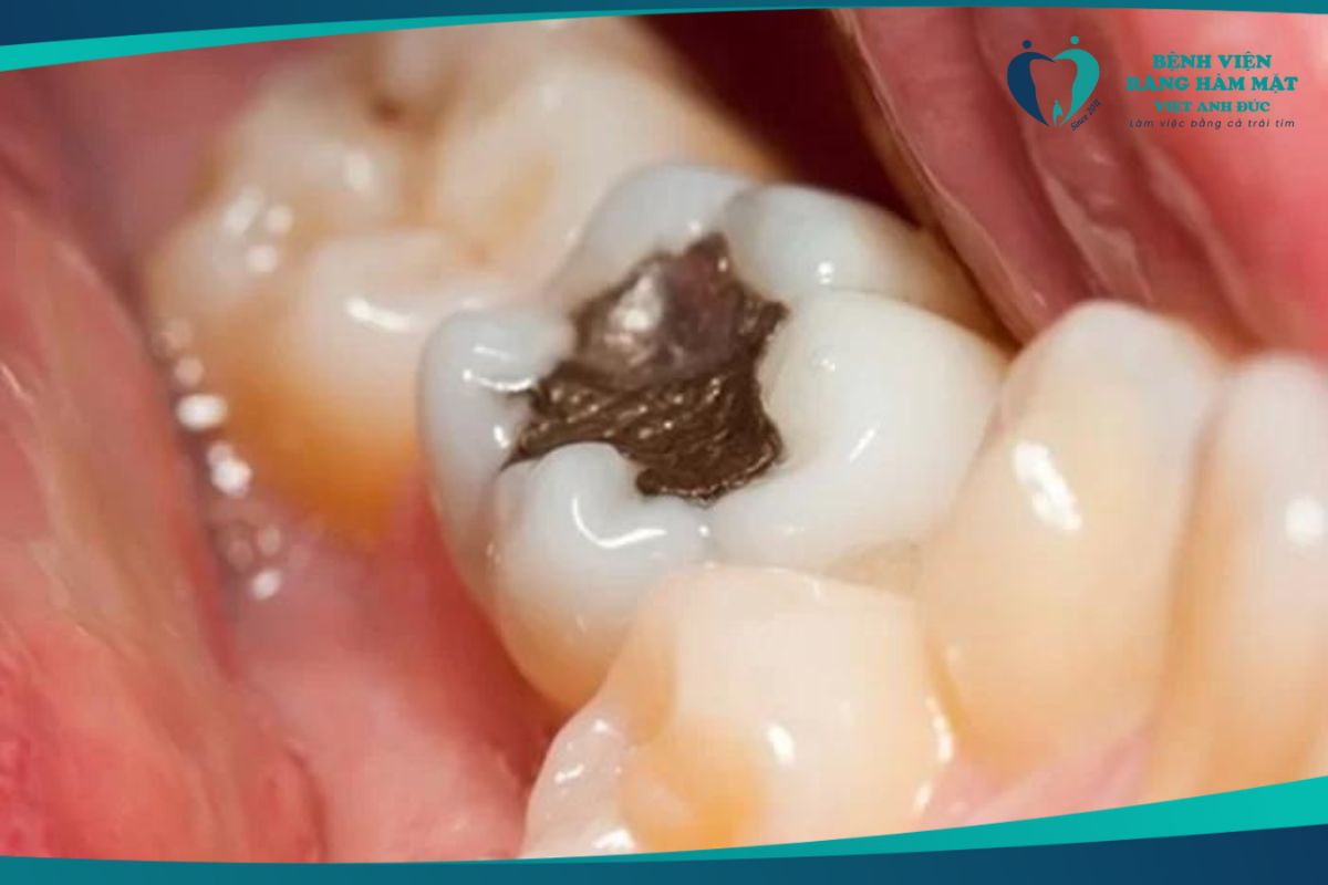 Trám răng thông thường
