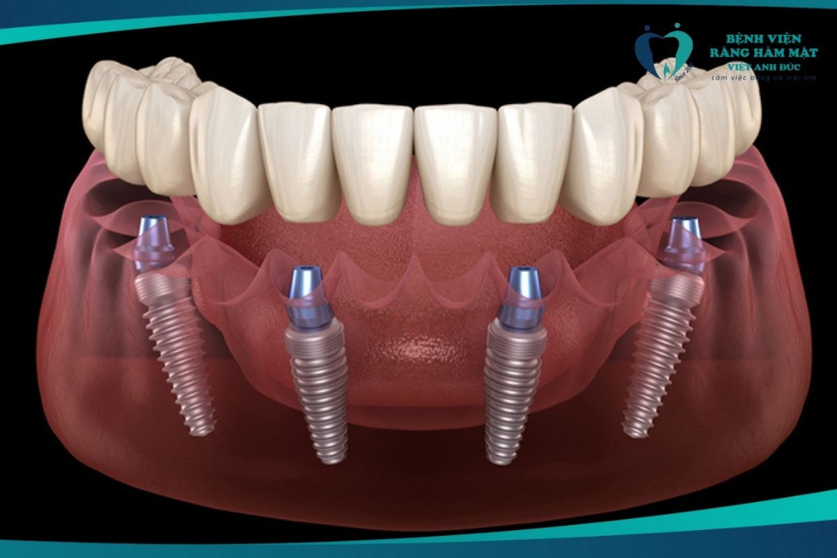 Trường hợp mất răng toàn hàm