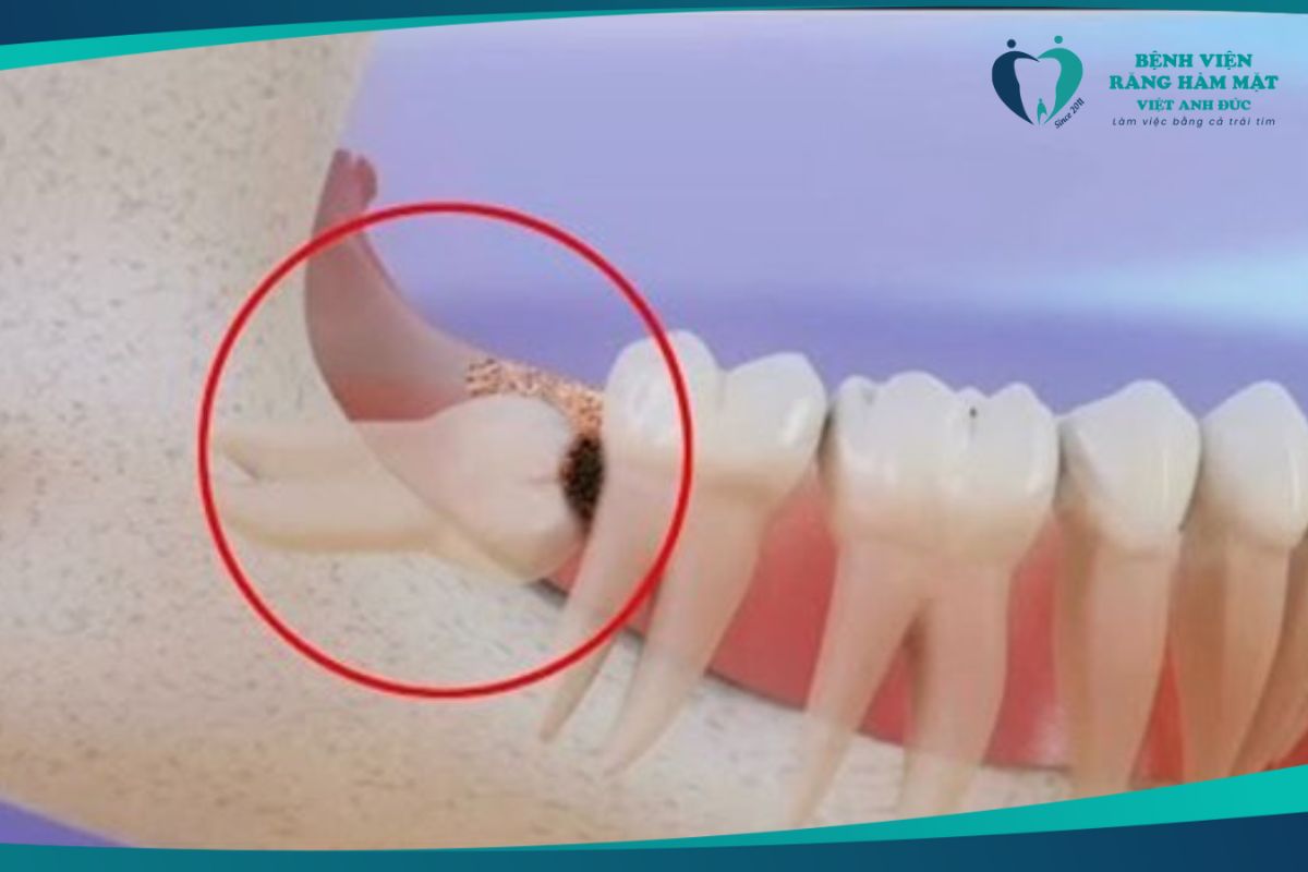 Răng khôn gây sâu răng