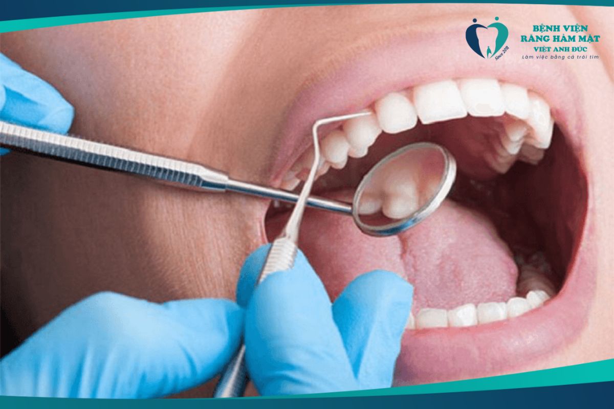 Cạo vôi răng điều trị viêm nha chu