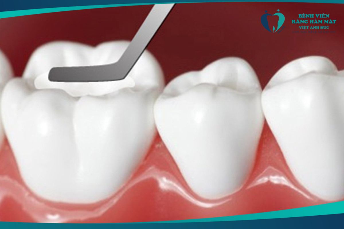 Trám răng thẩm mỹ