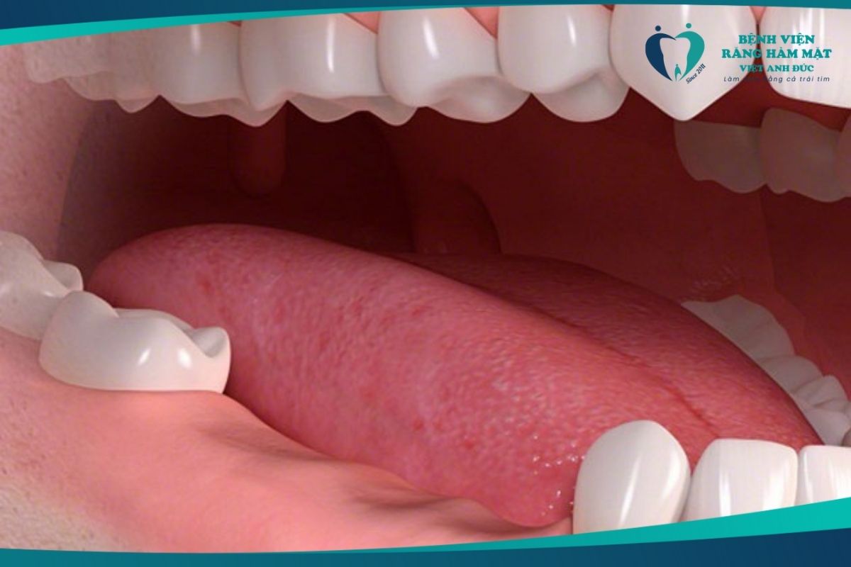 Trường hợp mất nhiều răng liên tiếp