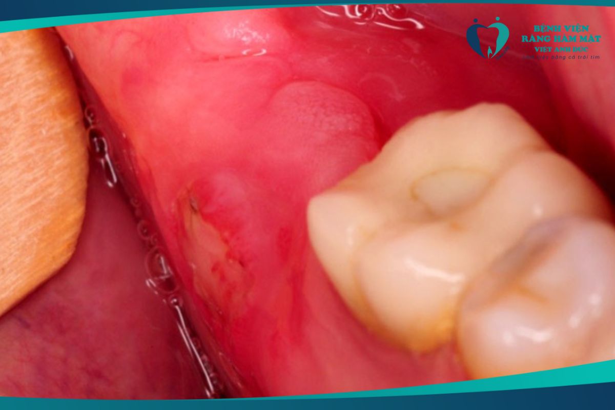 Răng khôn gây viêm lợi