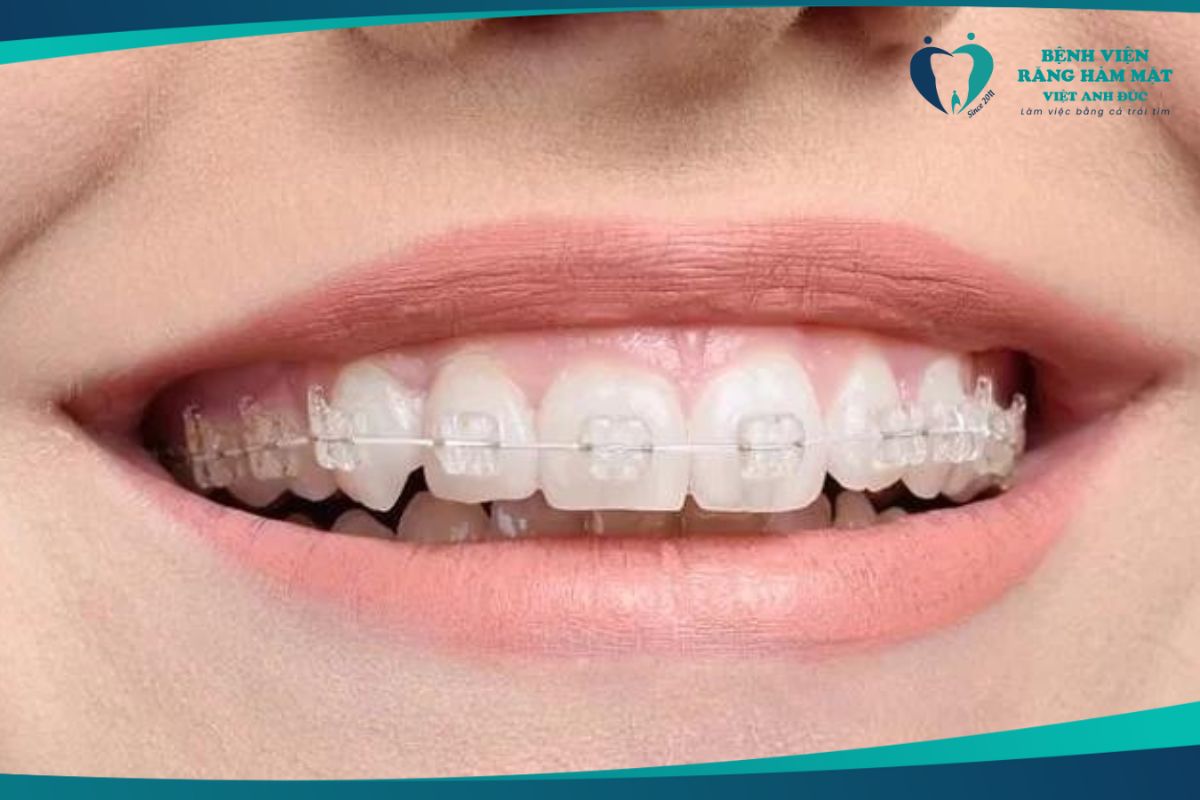 Niềng răng mắc cài sứ