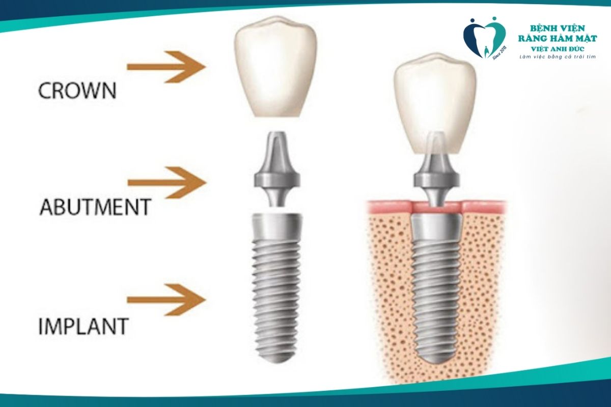 Cấu tạo răng Implant