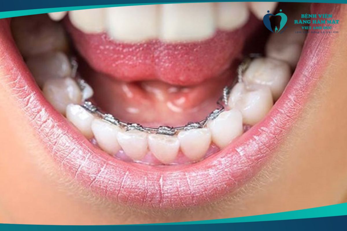 Niềng răng mắc cài mặt trong