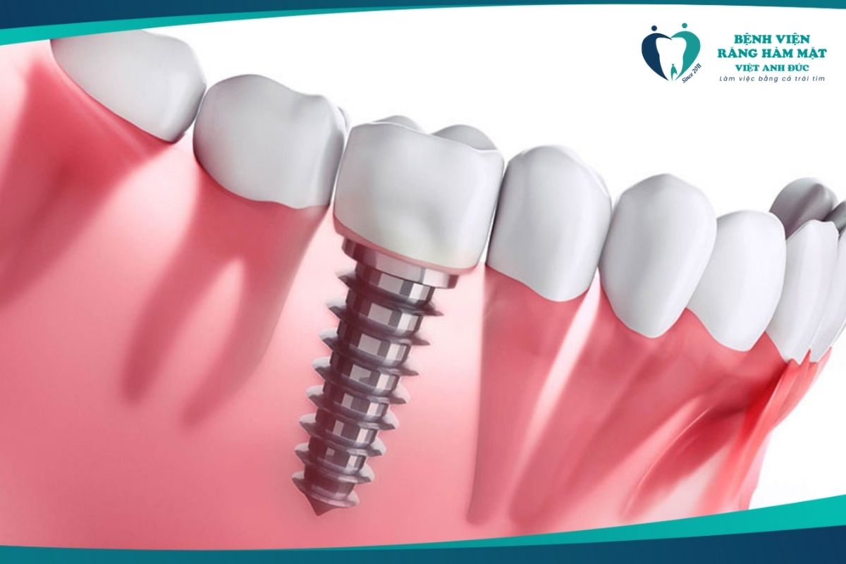 Trồng răng Implant
