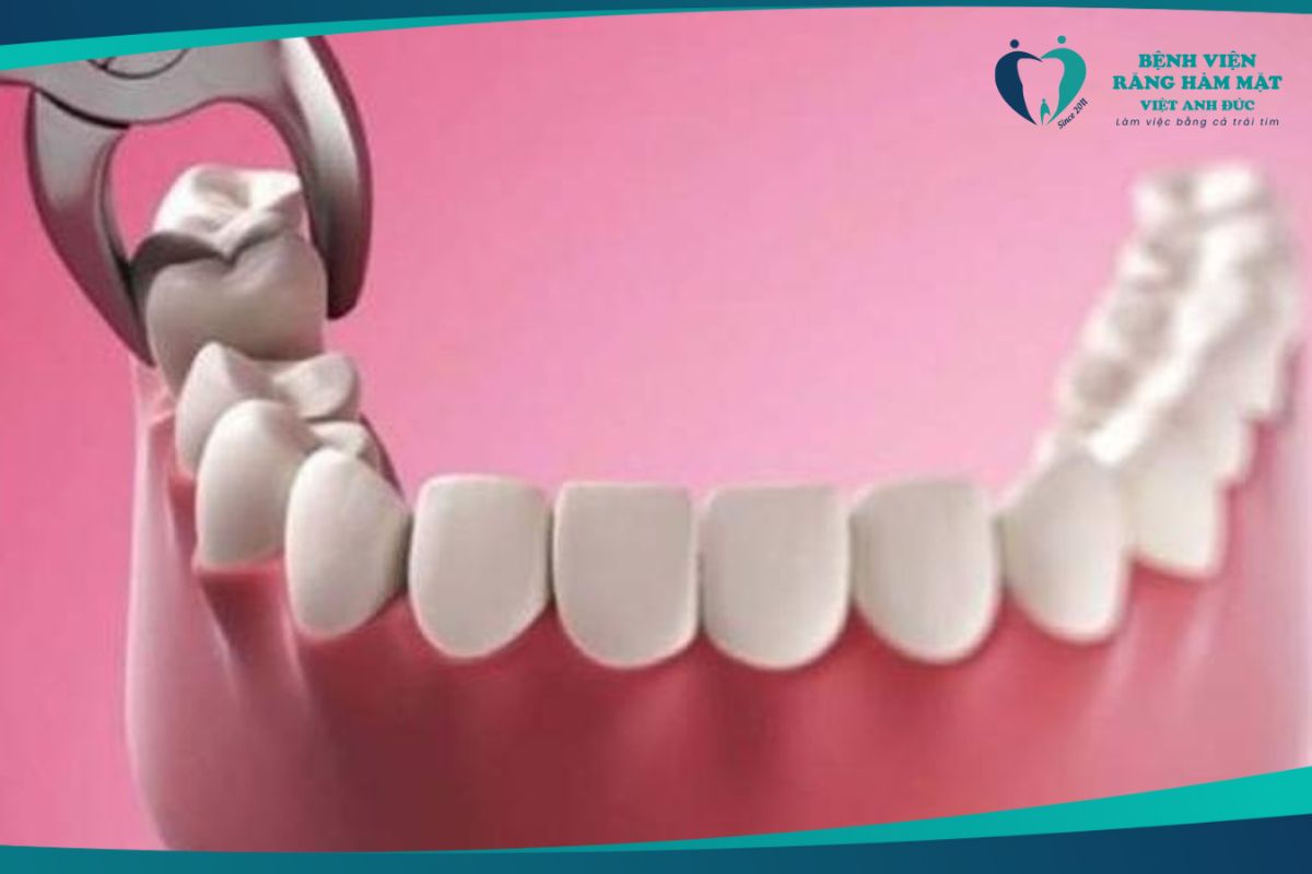 Thời điểm cần nhổ răng khôn