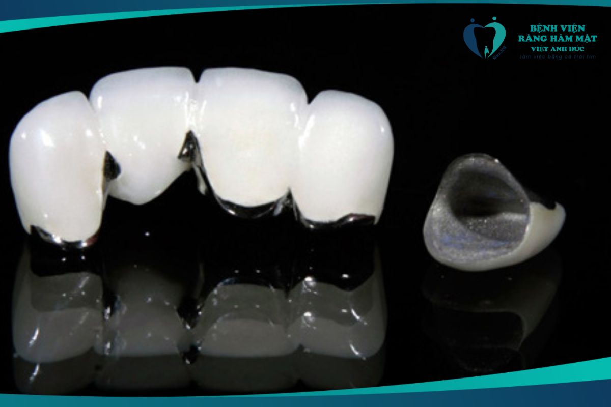 Phục hình sứ titan