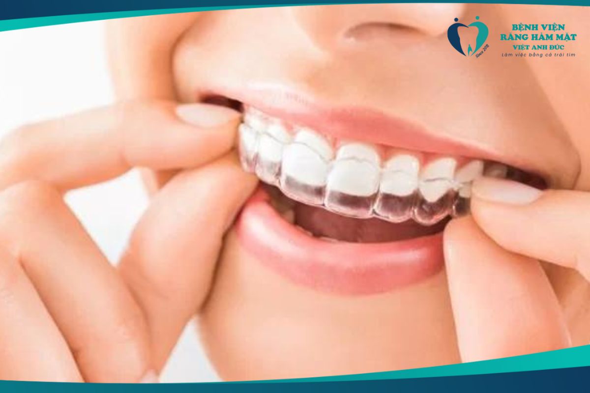 Niềng răng trong suốt Invisalign