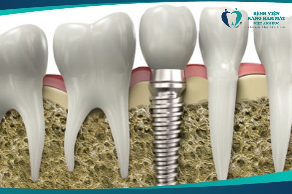 Phục hình cố định trên Implant