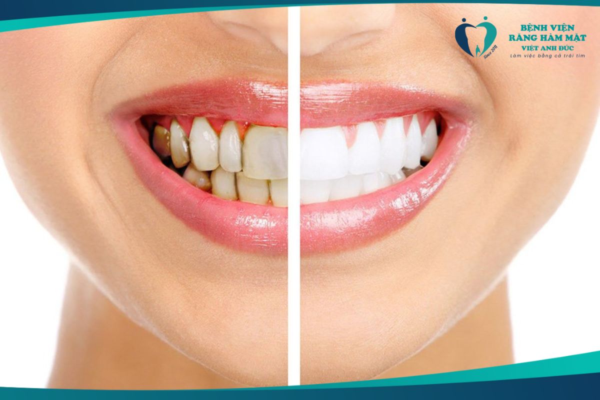 Trường hợp không áp dụng tẩy trắng răng