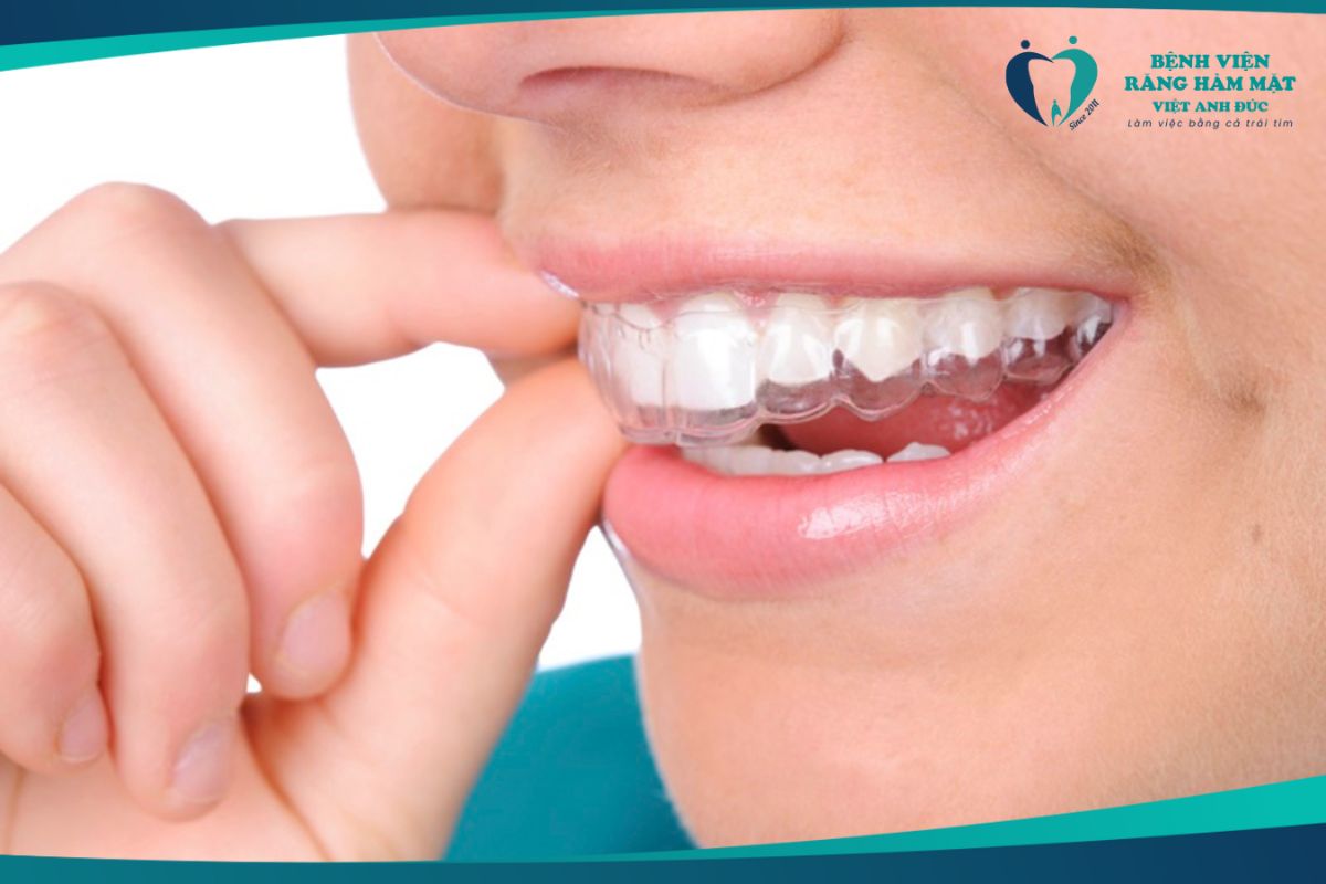 Tẩy trắng răng bằng máng