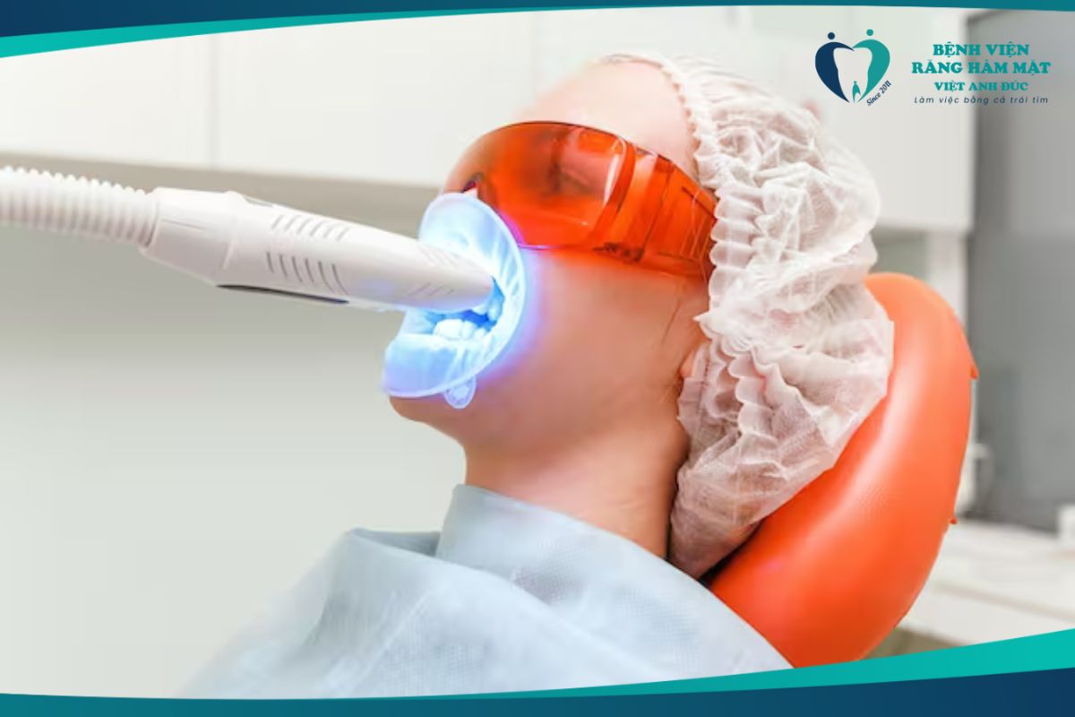 Tẩy trắng răng bằng Laser
