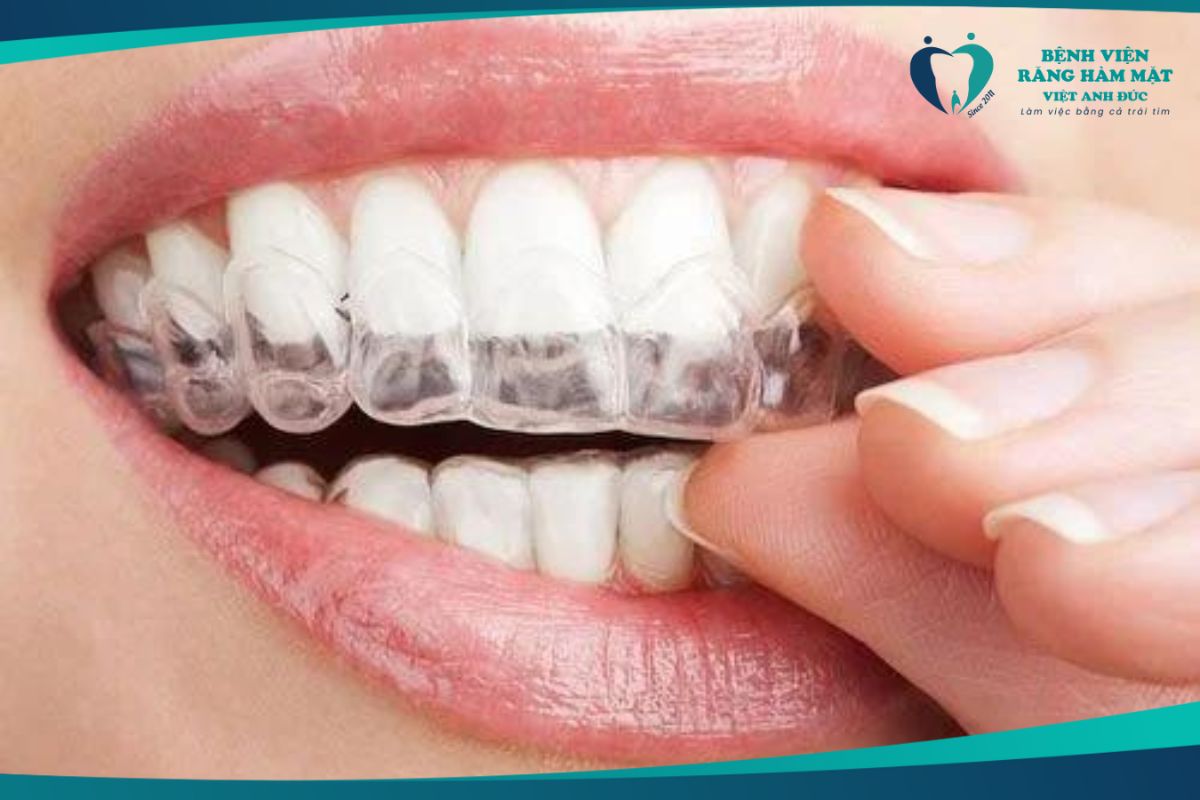 Niềng răng không mắc cài Clear Aligner