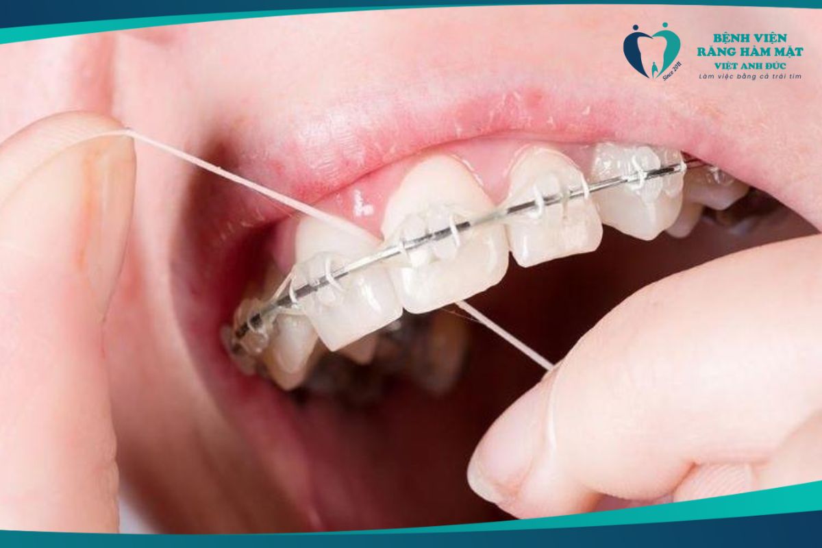 Chỉ nha khoa làm sạch kẽ răng