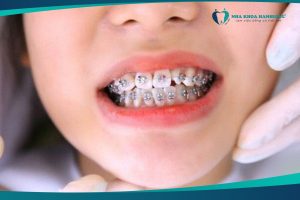 niềng răng trẻ em