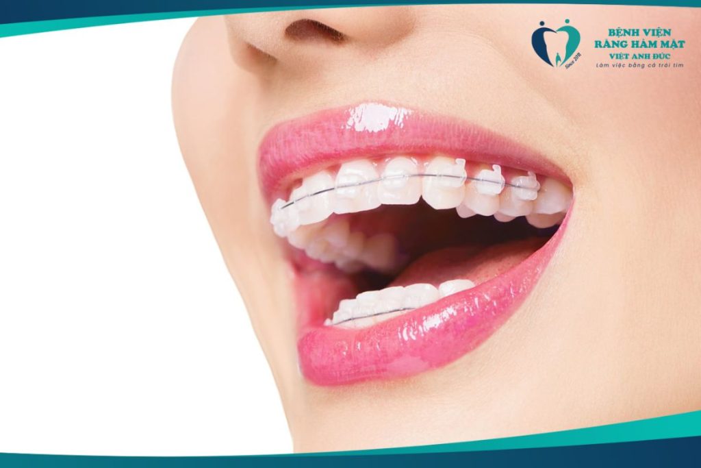 Niềng răng- Chỉnh nha