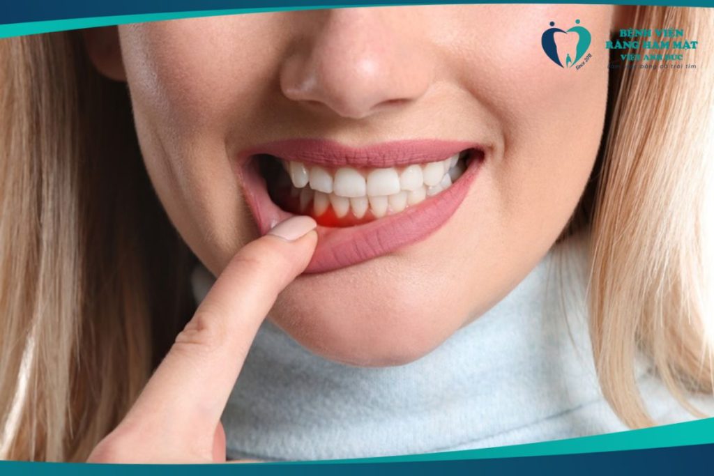 Bệnh viêm nha chu