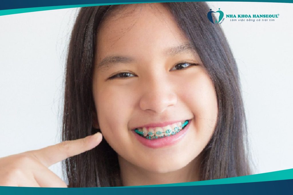 mắc cài cố định